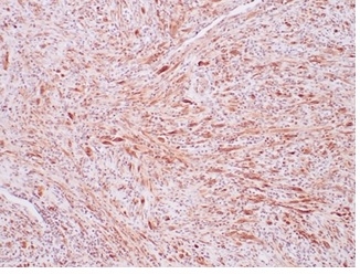 Formalin-fixed, paraffin-embedded human inflammatory myofibroblastic tumor (IMT) with ALK fusion stained with ALK/CD246 Antibody (ALK1/7008R) - Azide and BSA Free.