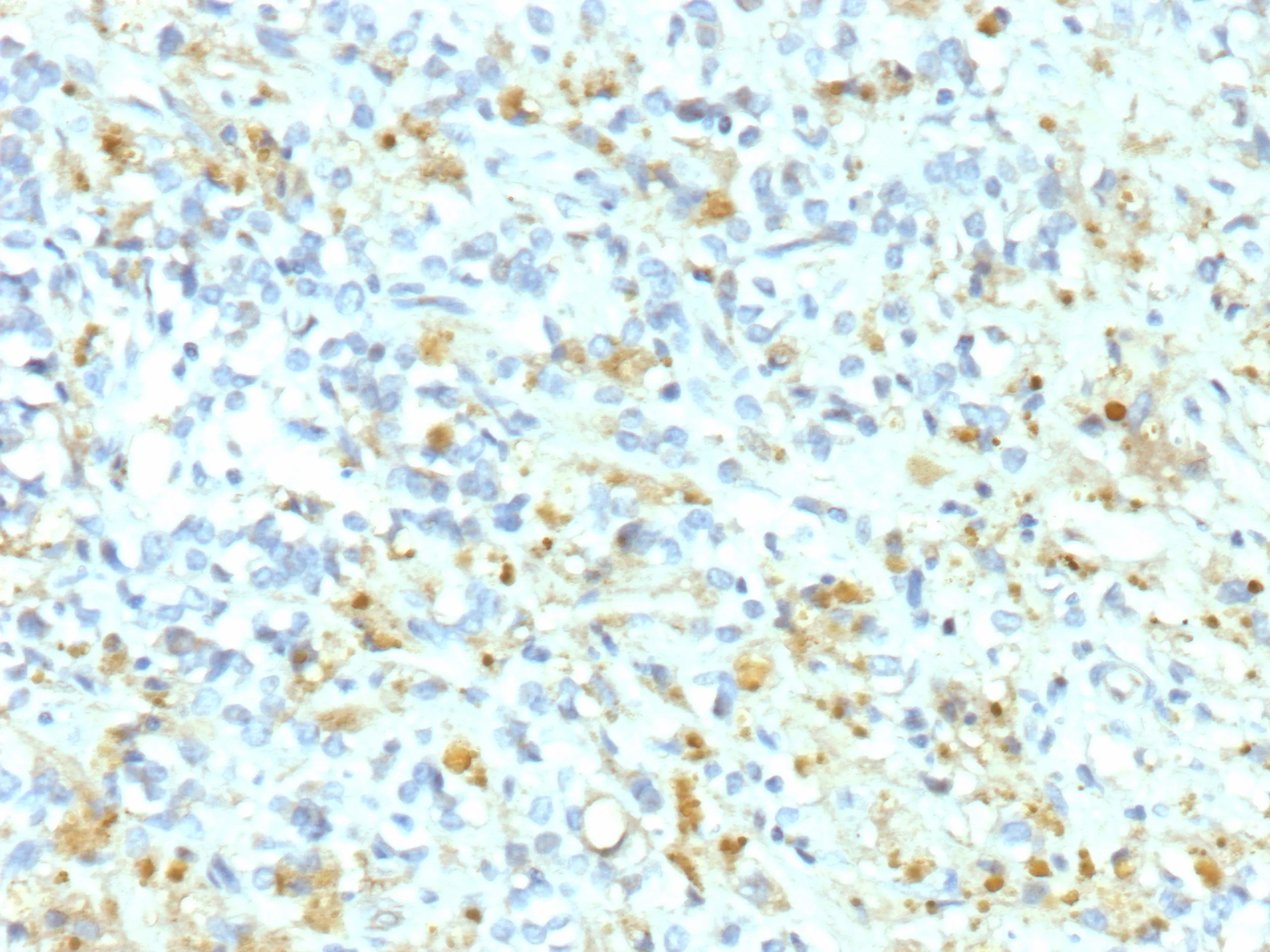 Formalin-fixed, paraffin-embedded human Ewing Sarcoma stained with ALK/CD246 Antibody (ALK1/9660R) - Azide and BSA Free. HIER: Tris/EDTA, pH9.0, 45min. 2 °: HRP-polymer, 30min. DAB, 5min.
