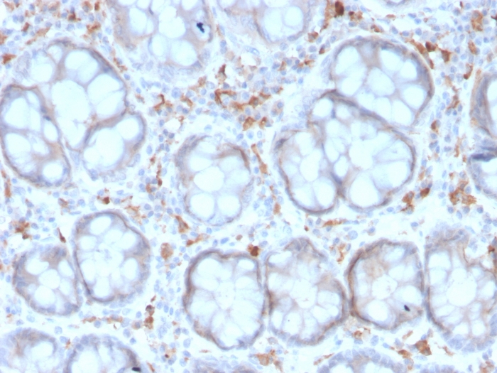 Formalin-fixed, paraffin-embedded human Colon Carcinoma stained with DC-SIGN/CD209 Antibody (rC209/1781) - Azide and BSA Free.