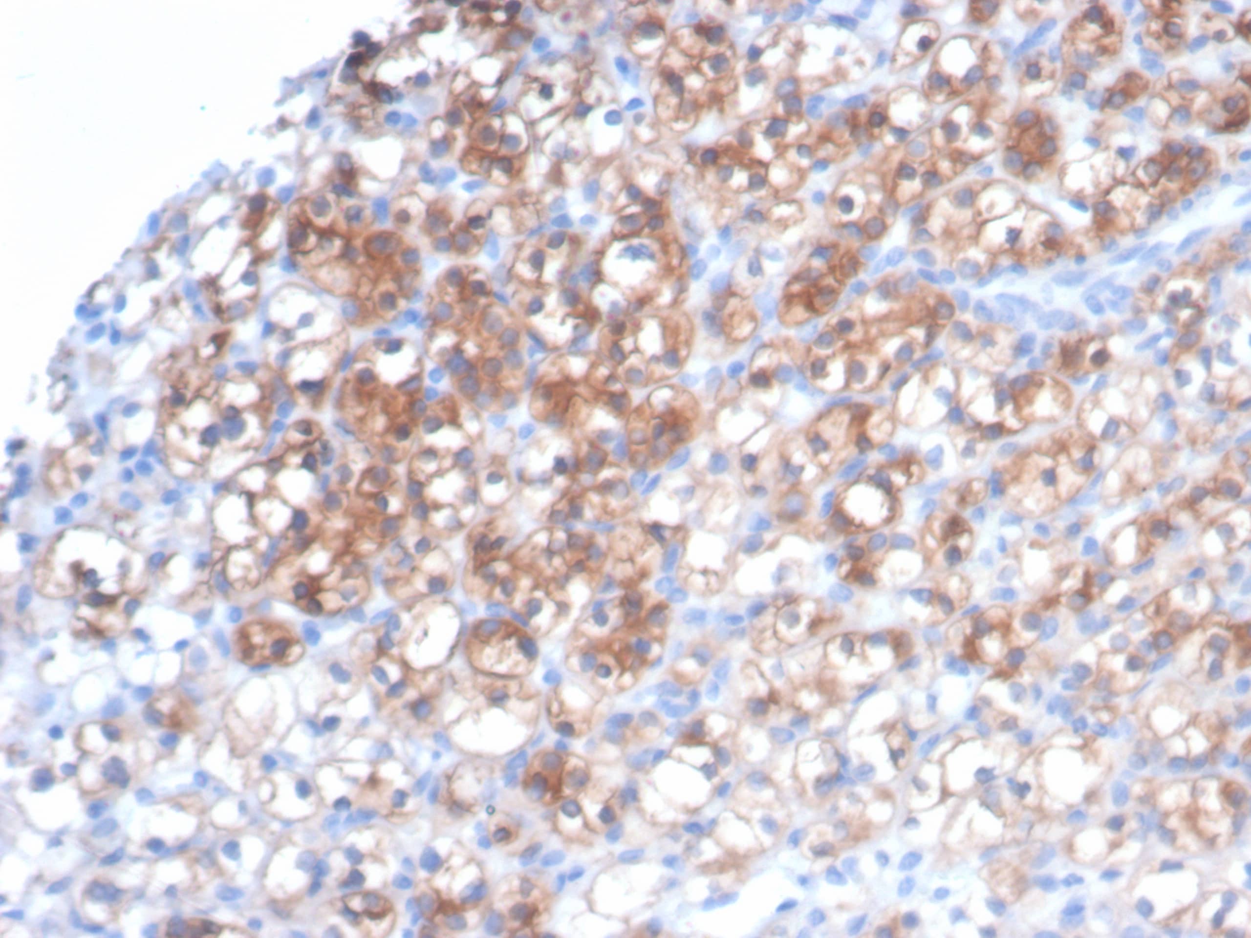 Formalin-fixed, paraffin-embedded human renal cell carcinoma (RCC) stained with HSP27 Antibody (HSPB1/7038R) - Azide and BSA Free. HIER: Tris/EDTA, pH9.0, 45min. 2�: HRP-polymer, 30min. DAB, 5min. 
