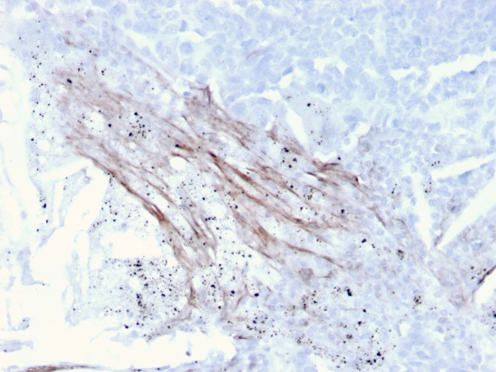 Formalin-fixed, paraffin-embedded human Lung Carcinoma stained with Tenascin C Antibody (rTNC/3635) - Azide and BSA Free.