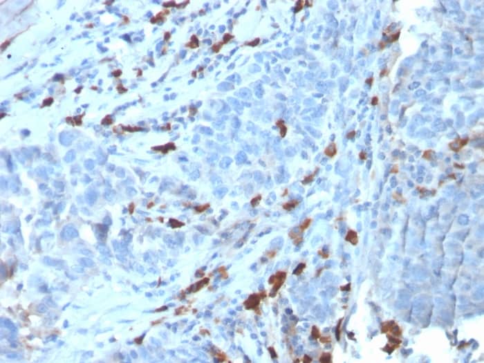 Formalin-fixed, paraffin-embedded human Tumor stained with IgM Antibody (IGHM/3135R) - Azide and BSA Free.