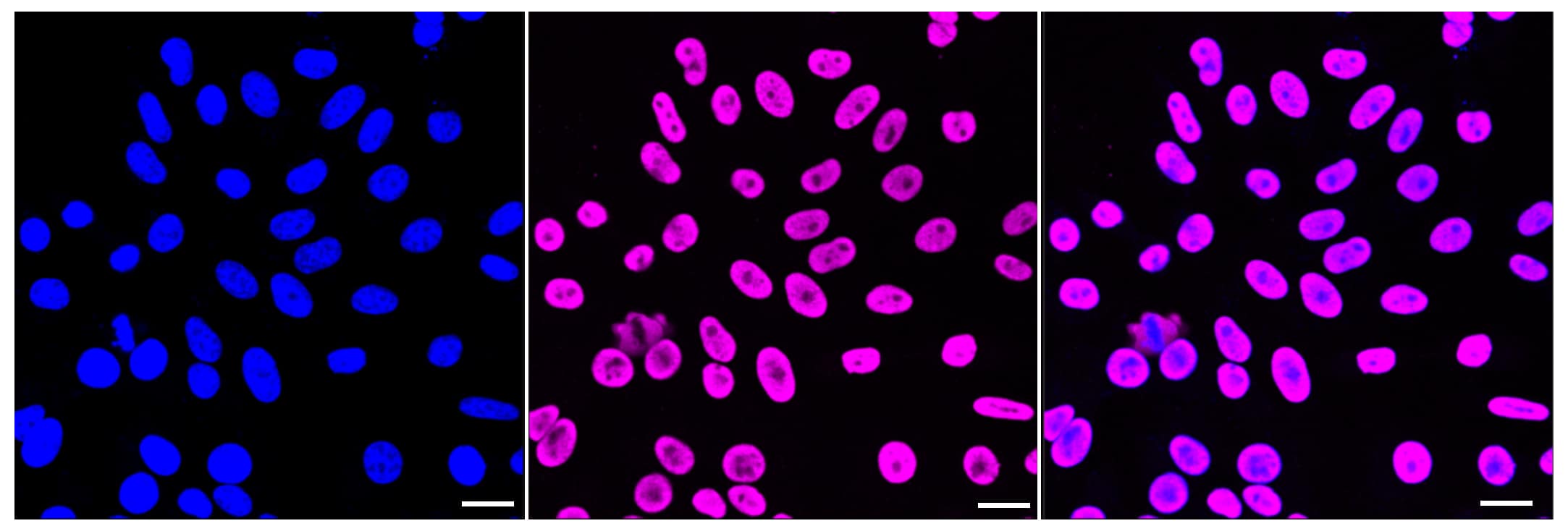 Immunocytochemical staining of HepG2 cells with NEDD4 antibody (1:1,000). Nuclei were stained blue with DAPI; NEDD4 was stained magenta with Alexa Fluor(R) 647. Images were taken using Leica stellaris 5. Protein abundance based on laser Intensity and smart gain: High. Scale bar, 20 um.