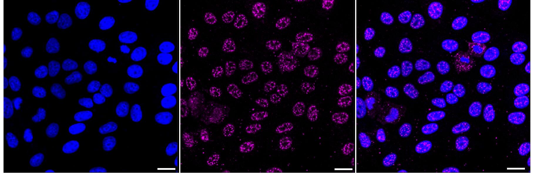 Immunocytochemical staining of HepG2 cells with EGFR antibody (1:1,000). Nuclei were stained blue with DAPI; EGFR was stained magenta with Alexa Fluor(R) 647. Images were taken using Leica stellaris 5. Protein abundance based on laser Intensity and smart gain: Medium. Scale bar, 20 um.