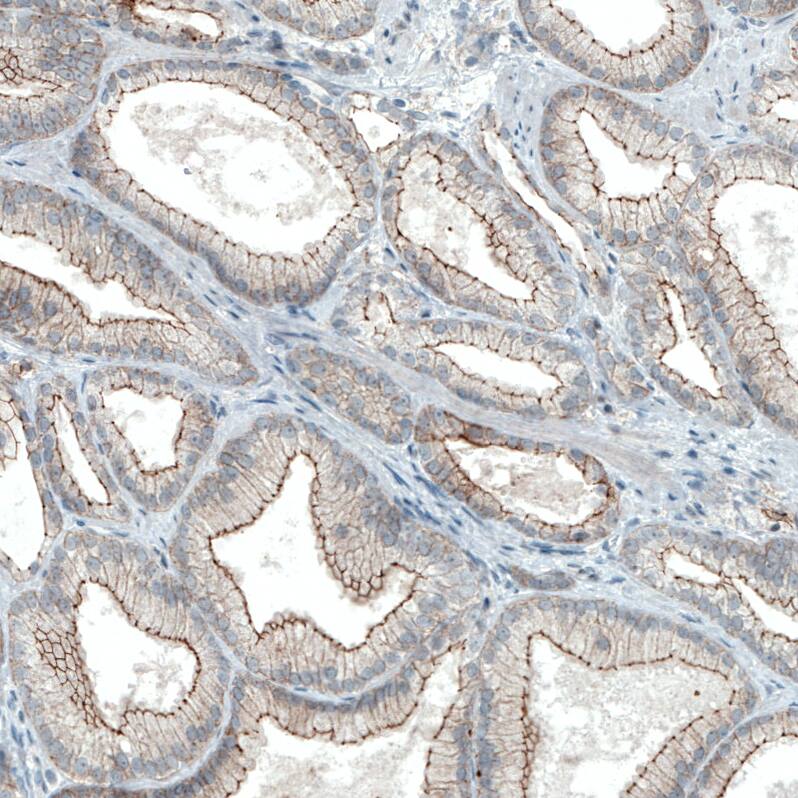 Staining of human prostate cancer shows strong apical membrane positivity in tumor cells.