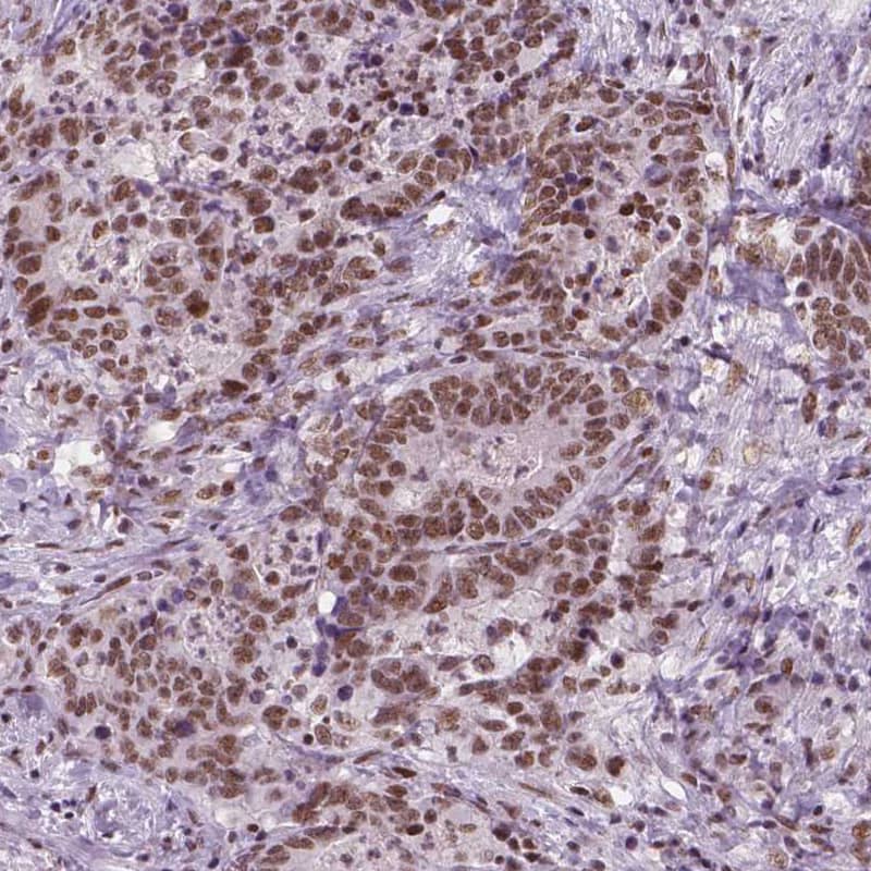 Staining of human stomach cancer shows moderate nuclear positivity in tumor cells.