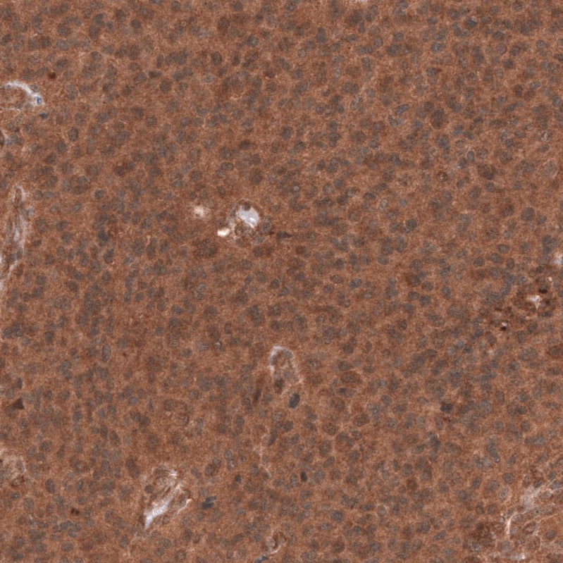 Staining of human anaplastic oligodendroglioma shows strong cytoplasmic positivity in tumor cells.