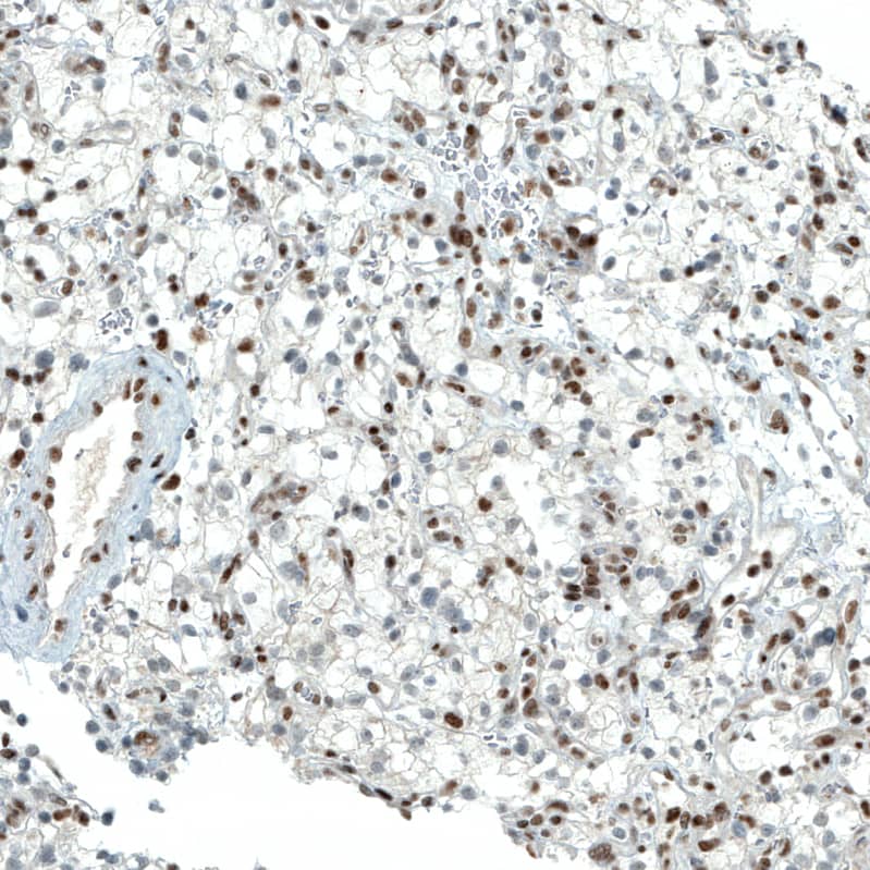 Staining of human kidney cancer shows moderate to strong nuclear positivity in tumor cells.