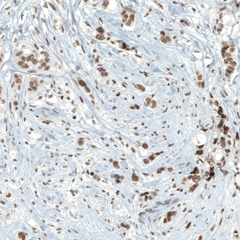 Staining of human breast cancer shows moderate to strong nuclear positivity in tumor cells.