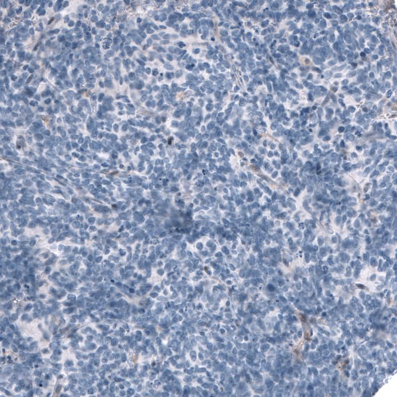 Staining of human lung tumor (small cell lung cancer) shows no positivity in tumor cells as expected.