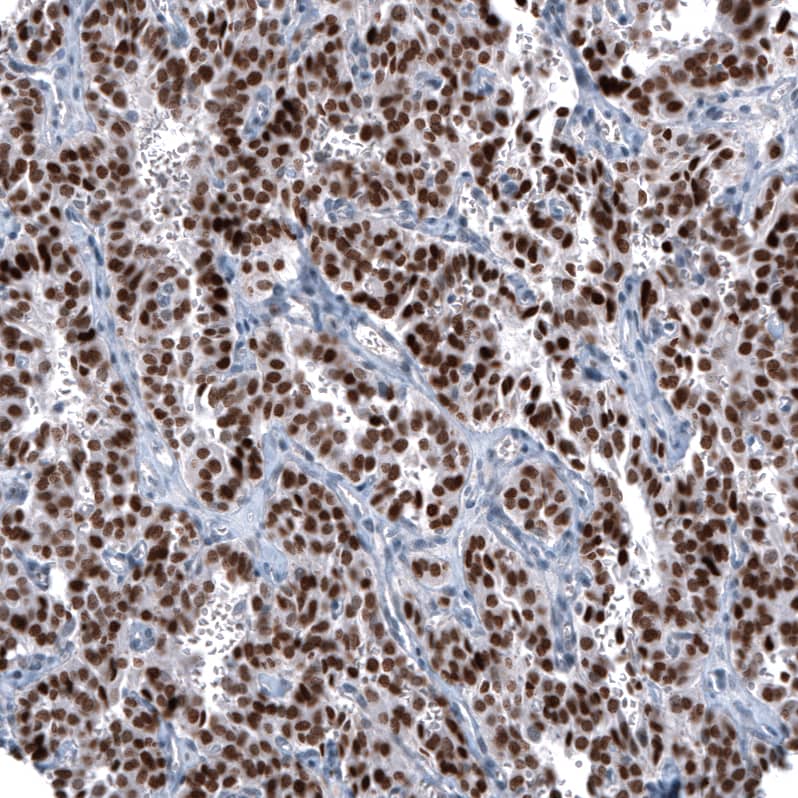 Staining of human lung tumor (typical carcinoid) shows strong nuclear positivity in tumor cells.