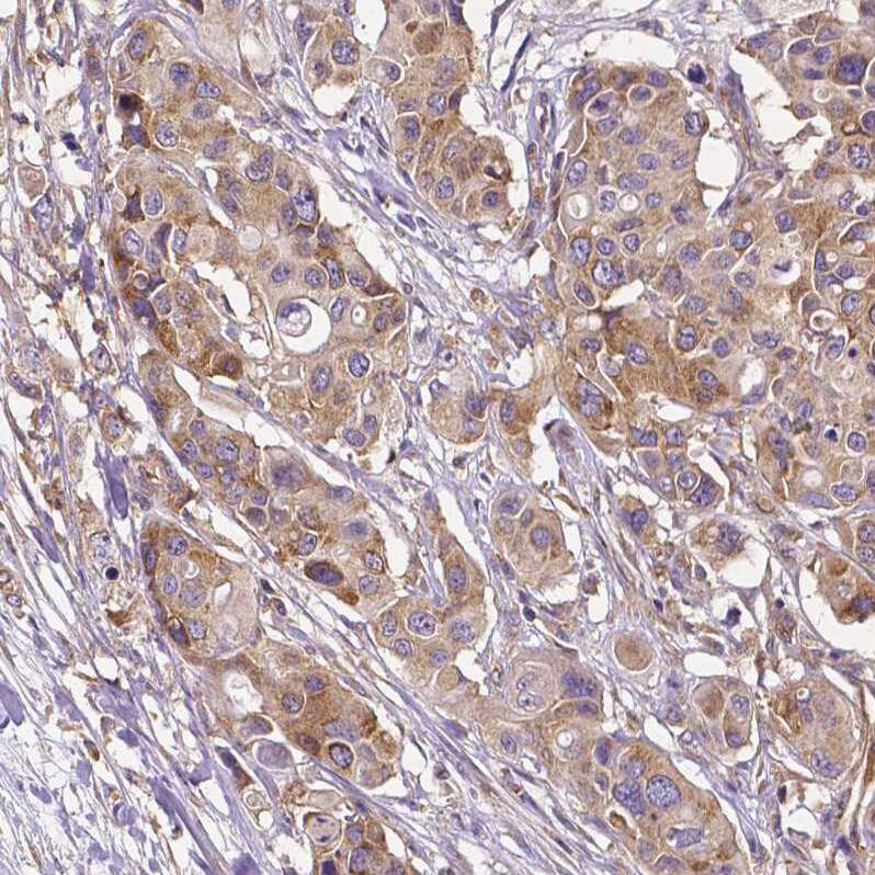Staining of human colorectal cancer shows moderate cytoplasmic positivity in tumor cells.