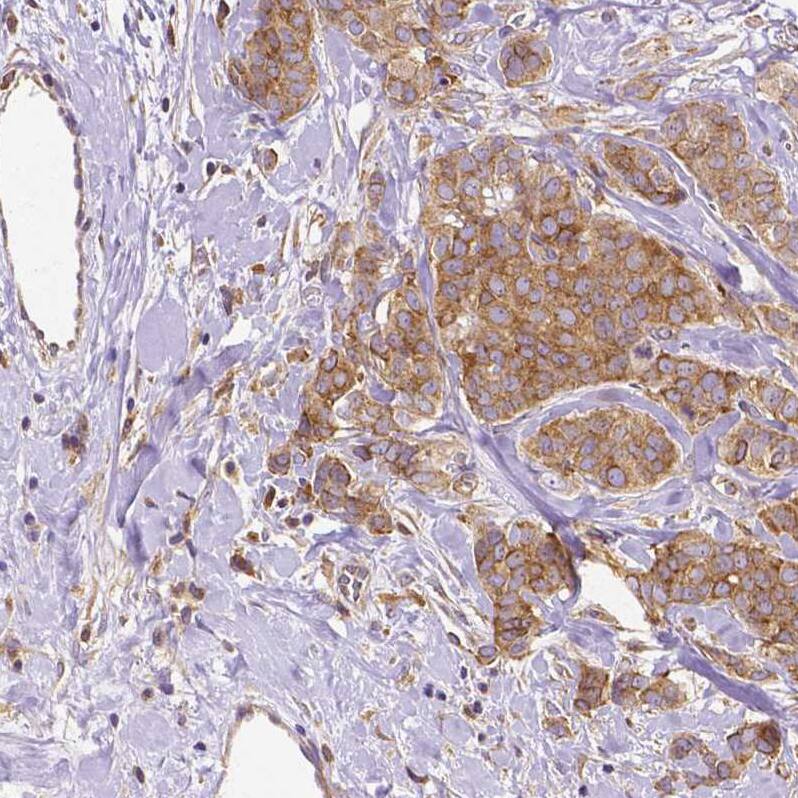 Staining of human breast cancer shows moderate cytoplasmic positivity in tumor cells.