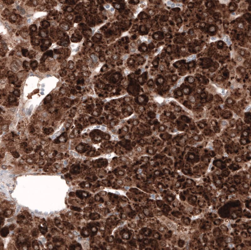 Staining of human liver cancer shows strong cytoplasmic positivity in tumor cells.
