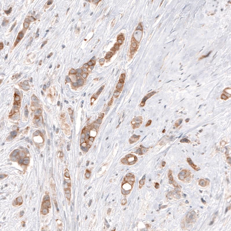 Staining of human breast cancer shows moderate cytoplasmic positivity in tumor cells.