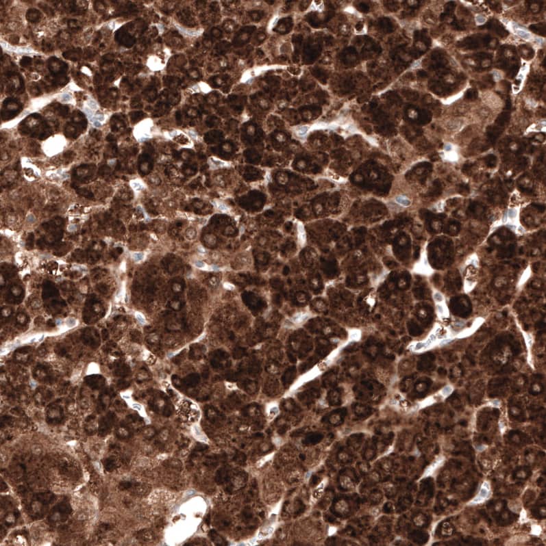 Staining of human liver cancer shows strong cytoplasmic positivity in tumor cells.