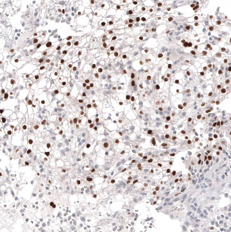 Staining of human renal cancer shows moderate nuclear positivity in tumor cells.