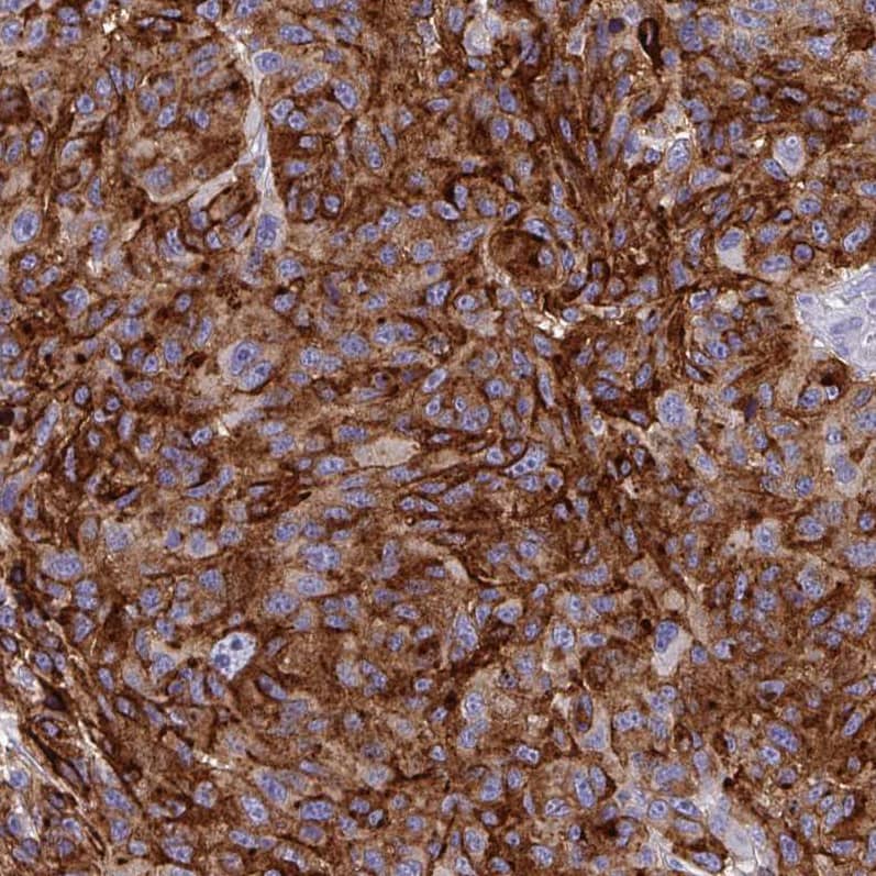 Staining of human malignant melanoma shows moderate to strong cytoplasmic positivity in tumor cells.
