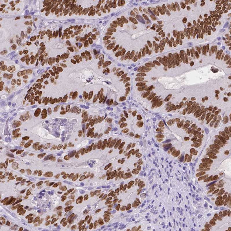 Staining of human colorectal cancer shows strong nuclear positivity in tumor cells.