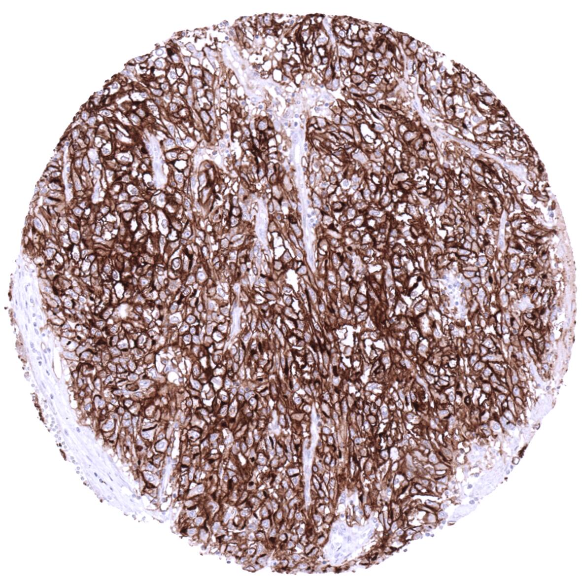 Clear cell renal cell carcinoma strong membranous ACE2 positivity.