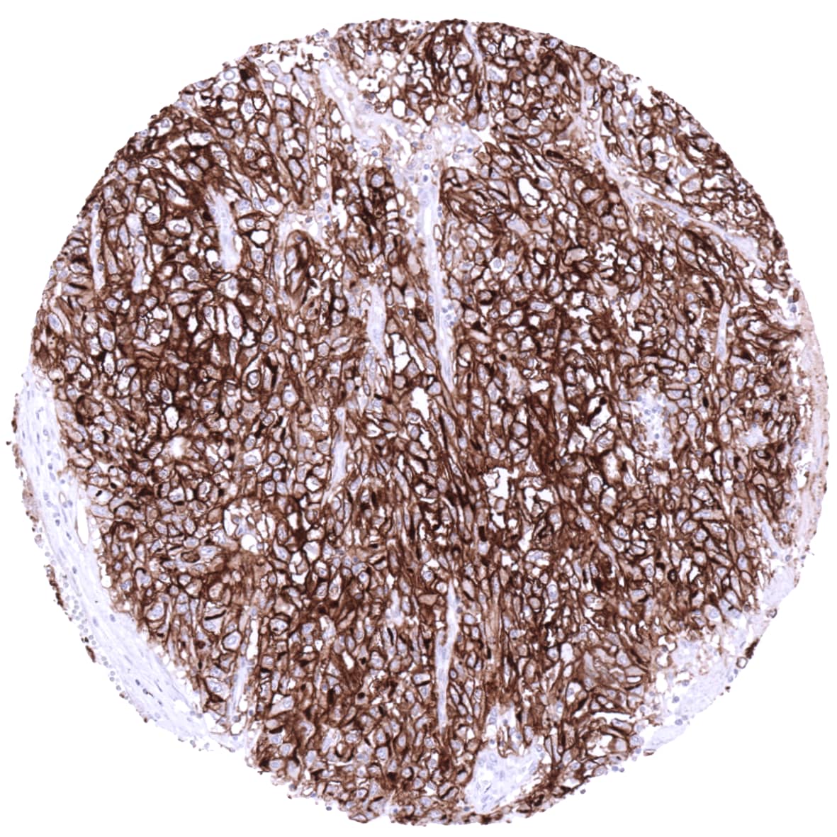 Clear cell renal cell carcinoma strong membranous ACE2 positivity.
