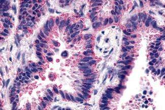 Immunohistochemistry: Frizzled-2 Antibody - BSA Free [NLS3488] - Immunohistochemistry of Lung, Non Small-Cell Carcinoma