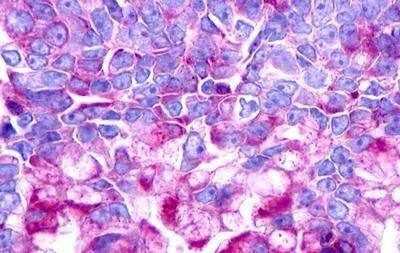 Immunohistochemistry: Urotensin-II R/GPR14 Antibody - BSA Free [NLS372] - Immunohistochemistry of Lung, Non Small-Cell Carcinoma