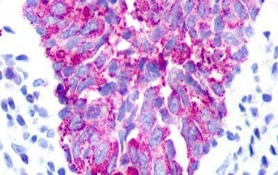 Immunohistochemistry: Urotensin-II R/GPR14 Antibody - BSA Free [NLS374] - Immunohistochemistry of Breast, Carcinoma