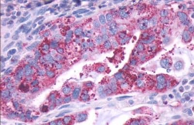 Immunohistochemistry: Dopamine D1R/DRD1 Antibody - BSA Free [NLS44] - Immunohistochemistry of Lung, Adenocarcinoma