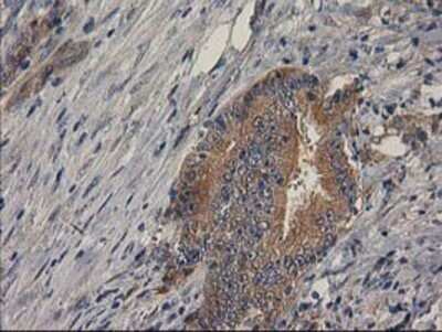 Immunohistochemistry: p130Cas/BCAR1 Antibody (OTI1A9) - Azide and BSA Free [NBP2-73181] - Staining of paraffin-embedded Adenocarcinoma of Human colon tissue using anti-BCAR1 mouse monoclonal antibody.