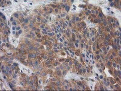 Immunohistochemistry: p130Cas/BCAR1 Antibody (OTI1A9) - Azide and BSA Free [NBP2-73181] - Staining of paraffin-embedded Carcinoma of Human bladder tissue using anti-BCAR1 mouse monoclonal antibody.