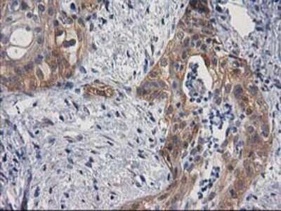 Immunohistochemistry: p130Cas/BCAR1 Antibody (OTI1A9) - Azide and BSA Free [NBP2-73181] - Staining of paraffin-embedded Carcinoma of Human pancreas tissue using anti-BCAR1 mouse monoclonal antibody.