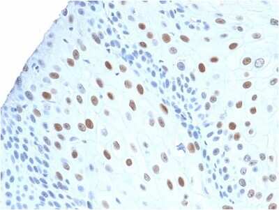 Immunohistochemistry-Paraffin: p21/CIP1/CDKN1A Antibody (CIP1/2275R) - Azide and BSA Free [NBP2-80489] - Formalin-fixed, paraffin-embedded human Urothelial Carcinoma stained with p21 Rabbit Recombinant Monoclonal Antibody (CIP1/2275R).