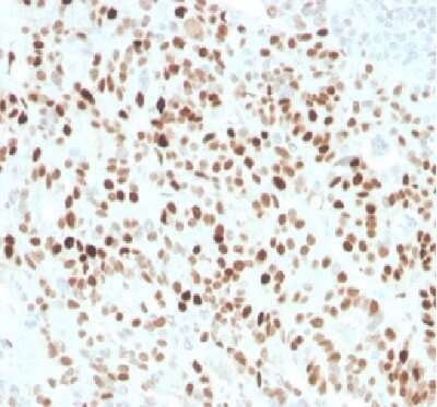 Immunohistochemistry-Paraffin: p21/CIP1/CDKN1A Antibody (CIP1/4377R) - Azide and BSA Free [NBP3-08961] - Formalin fixed paraffin embedded human colon carcinoma stained withp21/CIP1/CDKN1A Rabbit Recombinant Monoclonal Antibody (CIP1/4377R).