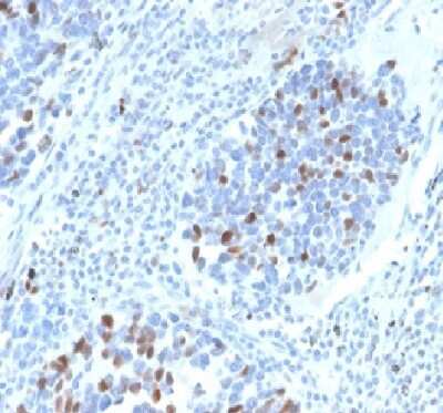 Immunohistochemistry-Paraffin: p21/CIP1/CDKN1A Antibody (CIP1/4377R) - Azide and BSA Free [NBP3-08961] - Formalin fixed paraffin embedded human lung carcinoma stained with p21/CIP1/CDKN1A Rabbit Recombinant Monoclonal Antibody (CIP1/4377R).
