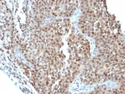 Immunohistochemistry-Paraffin: p21/CIP1/CDKN1A Antibody (CIP1/823 + DCS-60.2) - Azide and BSA Free [NBP2-47897] - Human Bladder Carcinoma stained with p21 Monoclonal Antibody (CIP1/823 + DCS-60.2).