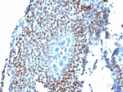 Immunohistochemistry-Paraffin: p21/CIP1/CDKN1A Antibody (CIP1/823) - Azide and BSA Free [NBP2-47783] - Human Bladder Carcinoma stained with p21 Monoclonal Antibody (CIP1/823).