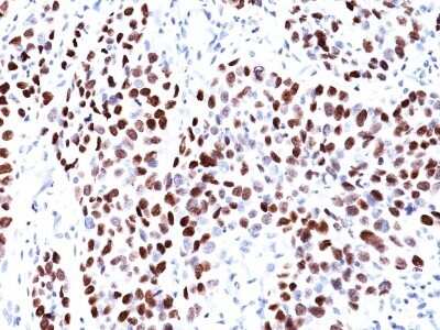 Immunohistochemistry-Paraffin: p21/CIP1/CDKN1A Antibody (CIP1/823) - Azide and BSA Free [NBP2-47783] - Human Lung Squamous Cell Carcinoma (SCC) stained with p21 Monoclonal Antibody (CIP1/823).