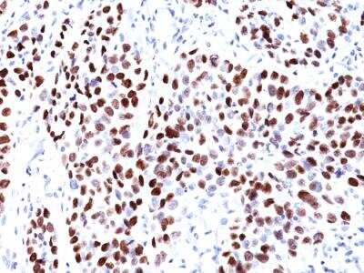 Immunohistochemistry-Paraffin: p21/CIP1/CDKN1A Antibody (CIP1/823) - IHC-Prediluted [NBP2-48371] - Formalin-fixed, paraffin-embedded human Lung SqCC stained with p21 Mouse Monoclonal Antibody (CIP1/823).