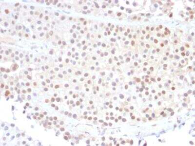 Immunohistochemistry-Paraffin: p21/CIP1/CDKN1A Antibody (DCS-60.2) - IHC-Prediluted [NBP2-48351] - Formalin-fixed, paraffin-embedded human Bladder Carcinoma stained with p21 Mouse Monoclonal Antibody (DCS-60.2).