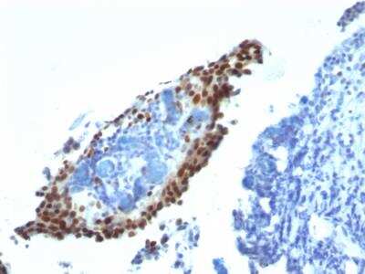 Immunohistochemistry-Paraffin: p21/CIP1/CDKN1A Antibody (HJ21) - IHC-Prediluted [NBP2-48383] - Formalin-fixed, paraffin-embedded Bladder Carcinoma stained with p21 Monoclonal Antibody (HJ21).