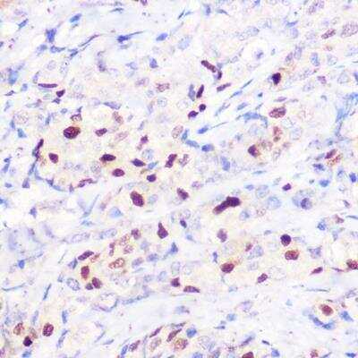 Immunohistochemistry-Paraffin: p21/CIP1/CDKN1A Antibody [NBP3-03297] - Human breast cancer using [KO Validated] CDKN1A/p21CIP1 Rabbit pAb at dilution of 1:100 (40x lens).Perform high pressure antigen retrieval with 10 mM citrate buffer pH 6.0 before commencing with IHC staining protocol.