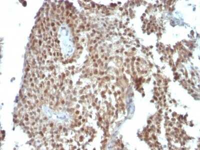 Immunohistochemistry-Paraffin: p21/CIP1/CDKN1A Antibody (SPM306) - Azide and BSA Free [NBP2-47782] - Human Colon Carcinoma stained with p21 Monoclonal Antibody (SPM306).