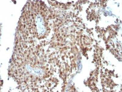 Immunohistochemistry-Paraffin: p21/CIP1/CDKN1A Antibody (SPM306) - IHC-Prediluted [NBP2-48352] - Formalin-fixed, paraffin-embedded human Colon Carcinoma stained with p21 Monoclonal Antibody (SPM306).