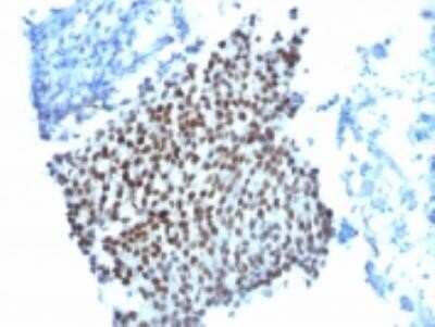 Immunohistochemistry-Paraffin: p21/CIP1/CDKN1A Antibody (WA-1) - Azide and BSA Free [NBP2-33084] - Formalin-fixed, paraffin-embedded human bladder carcinoma stained with p21 Monoclonal Antibody (WA-1).