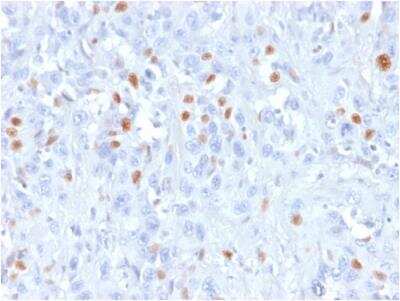 Immunohistochemistry-Paraffin: p21/CIP1/CDKN1A Antibody (rCIP1/823) - Azide Free [NBP3-09174] - Formalin-fixed, paraffin-embedded human Urothelial carcinoma stained with p21 Mouse Recombinant Monoclonal Antibody (rCIP1/823).