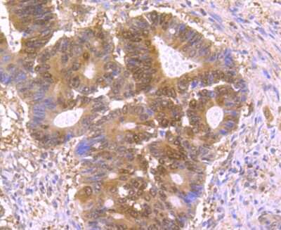 Immunohistochemistry-Paraffin: p23/PTGES3 Antibody (JU09-31) [NBP2-75603] - Analysis of paraffin-embedded human colon cancer tissue using anti-p23 antibody. Counter stained with hematoxylin.