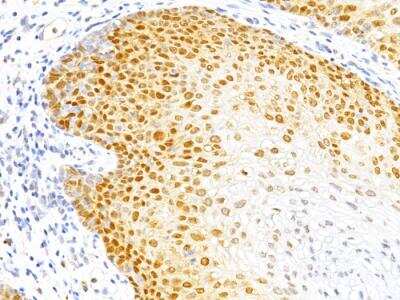 Immunohistochemistry-Paraffin: p27/Kip1 Antibody (DCS-72.F6) - IHC-Prediluted [NBP2-48400] - Formalin-fixed, paraffin-embedded human Cervical Cancer stained with p27 Monoclonal Antibody (DCS-72.F6)