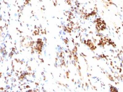 Immunohistochemistry-Paraffin: p27/Kip1 Antibody (DCS-72.F6) - IHC-Prediluted [NBP2-48400] - Formalin-fixed, paraffin-embedded human Colon Cancer stained with p27 Monoclonal Antibody (DCS-72.F6)