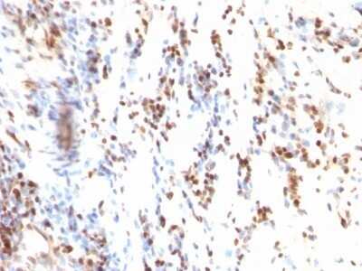 Immunohistochemistry-Paraffin: p27/Kip1 Antibody (KIP1/769) - Azide and BSA Free [NBP2-47769] - Human Colon Carcinoma stained with p27 Monoclonal Antibody (KIP1/769)